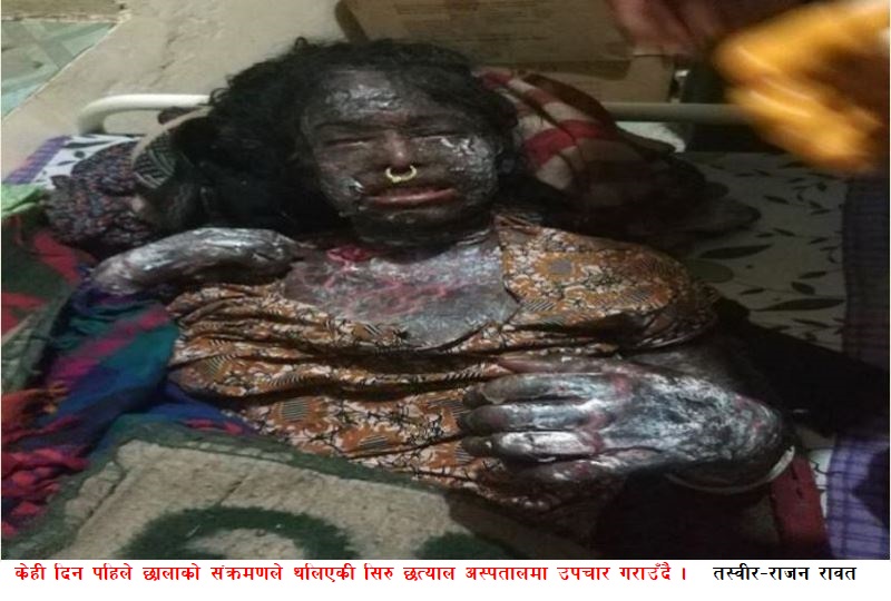 कुष्ठरोग लागेको भन्दै घर भित्र लुकाइएकी महिलाको सफल उपचार